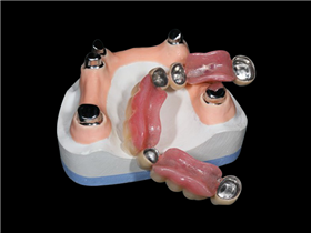 Telescope crowns combo with framework