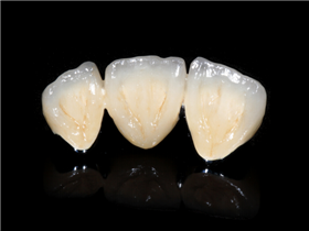 钴铬合金烤瓷牙