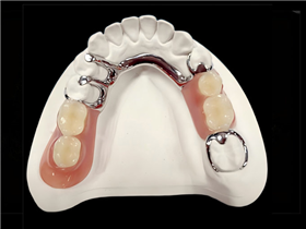 Cast  framework  with  teeth