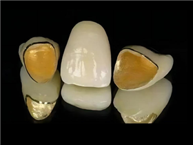 贵金属烤瓷牙
